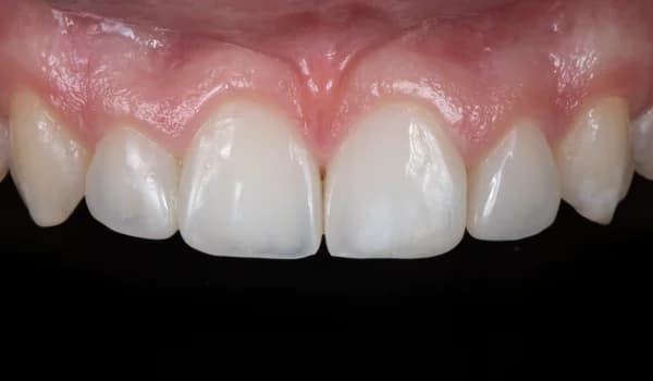 Estetické premeny - prípad 14 – po ošetrení v Planeta Dental Clinic v Žiline