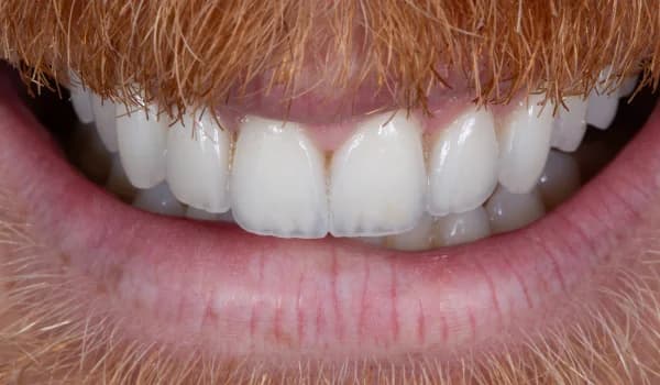 Estetické premeny - prípad 6 – po ošetrení v Planeta Dental Clinic v Žiline