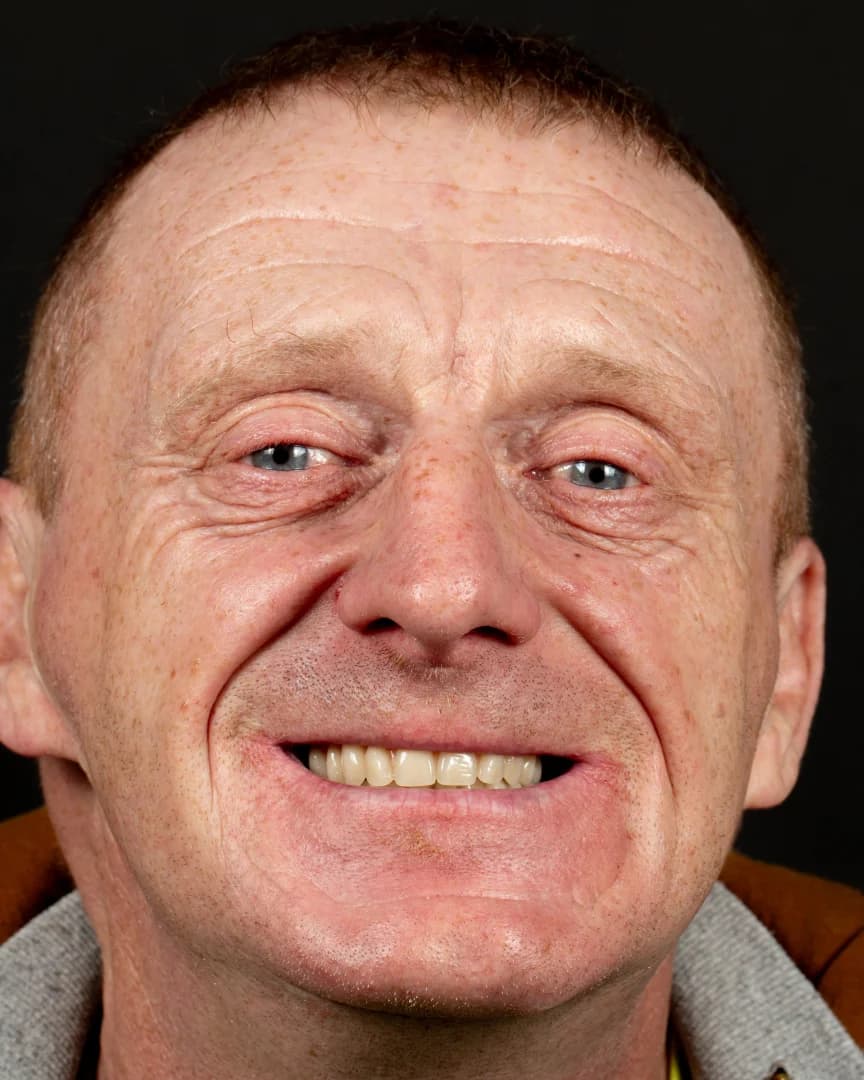 Celkové rekonštrukcie - prípad 5 – po ošetrení v Planeta Dental Clinic v Žiline