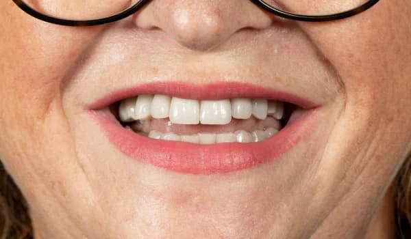 Estetické premeny - prípad 3 – po ošetrení v Planeta Dental Clinic v Žiline