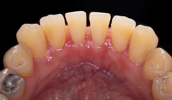 Dentálna hygiena - prípad 1 – po ošetrení v Planeta Dental Clinic v Žiline