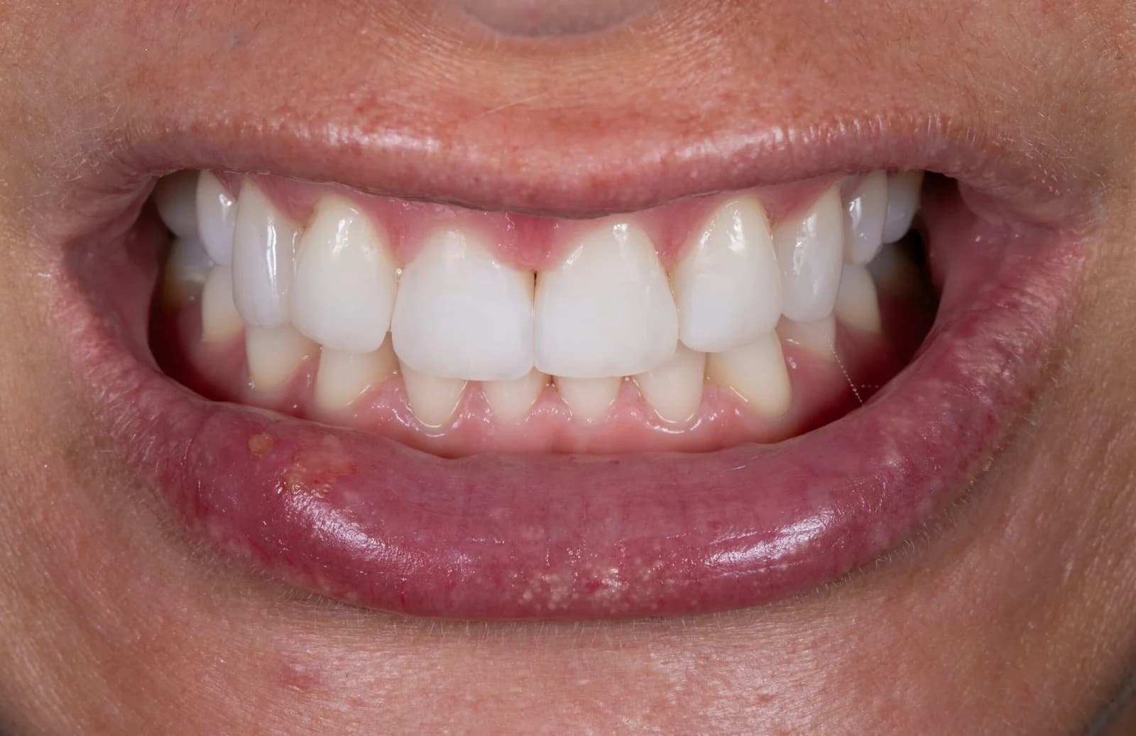 Estetické premeny - prípad 7 – po ošetrení v Planeta Dental Clinic v Žiline