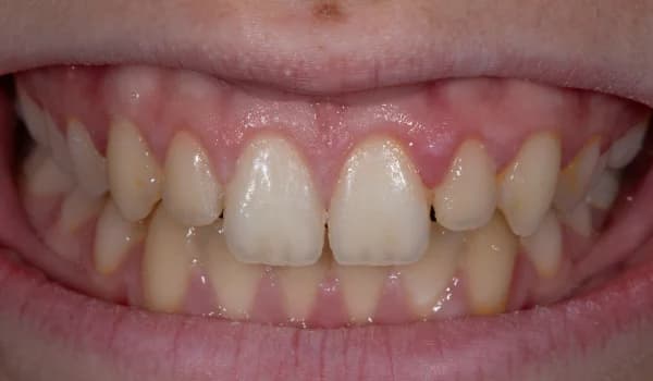 Úrazy - prípad 1 – po ošetrení v Planeta Dental Clinic v Žiline