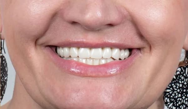 Estetické premeny - prípad 4 – po ošetrení v Planeta Dental Clinic v Žiline
