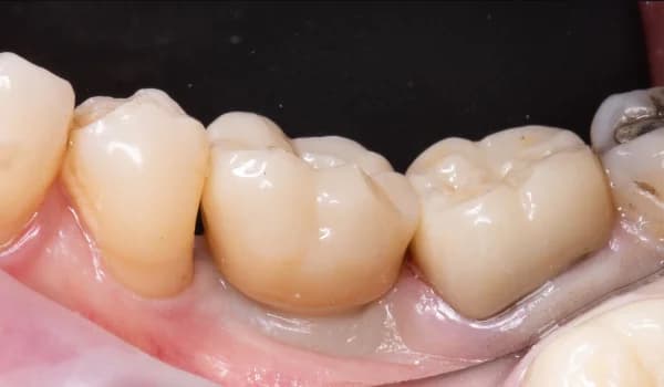 Zubné implantáty - prípad 1 – po ošetrení v Planeta Dental Clinic v Žiline