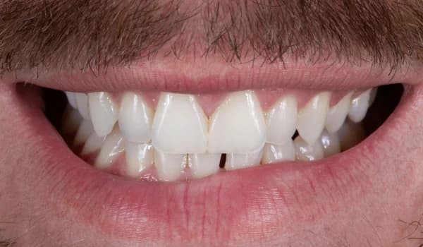 Estetické premeny - prípad 5 – po ošetrení v Planeta Dental Clinic v Žiline