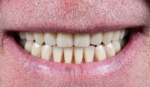 Estetické premeny - prípad 10 – po ošetrení v Planeta Dental Clinic v Žiline