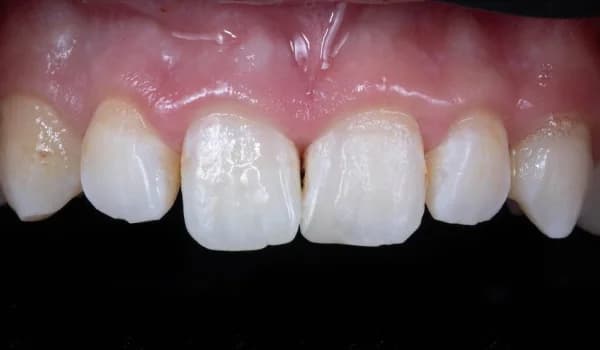 Úrazy - prípad 3 – po ošetrení v Planeta Dental Clinic v Žiline