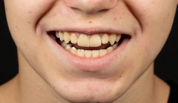 Estetické premeny - prípad 2 – po ošetrení v Planeta Dental Clinic v Žiline