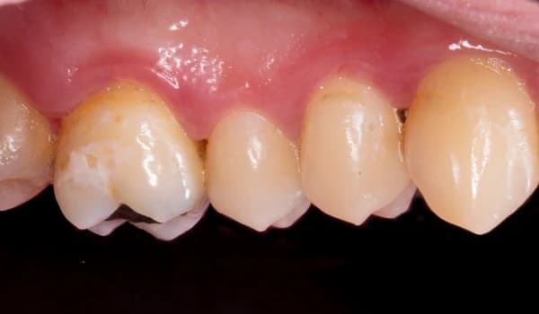 Dentálna hygiena - prípad 2 – po ošetrení v Planeta Dental Clinic v Žiline