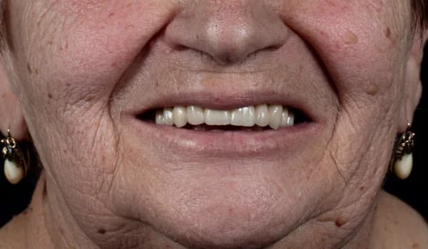 Estetické premeny - prípad 1 – po ošetrení v Planeta Dental Clinic v Žiline