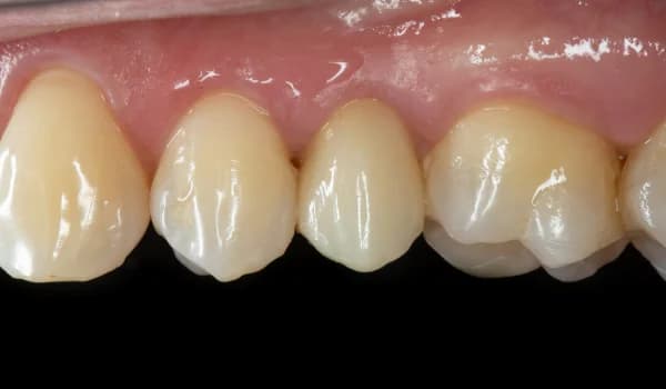 Zubné implantáty - prípad 3 – po ošetrení v Planeta Dental Clinic v Žiline