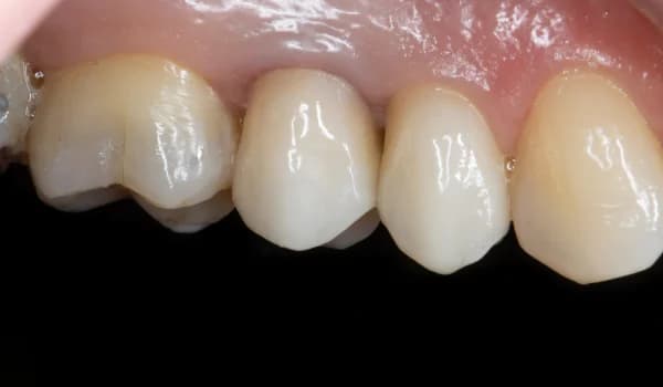 Zubné implantáty - prípad 4 – po ošetrení v Planeta Dental Clinic v Žiline
