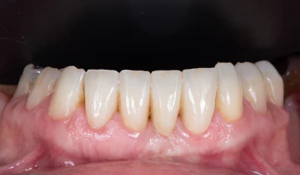 Estetické premeny - prípad 16 – po ošetrení v Planeta Dental Clinic v Žiline