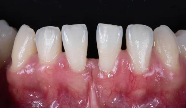 Dentálna hygiena - prípad 3 – po ošetrení v Planeta Dental Clinic v Žiline