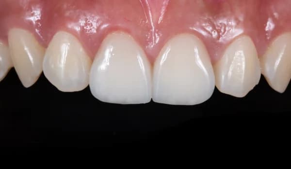 Estetické premeny - prípad 15 – po ošetrení v Planeta Dental Clinic v Žiline