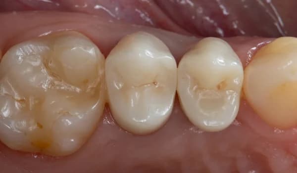 Zubné implantáty - prípad 2 – po ošetrení v Planeta Dental Clinic v Žiline