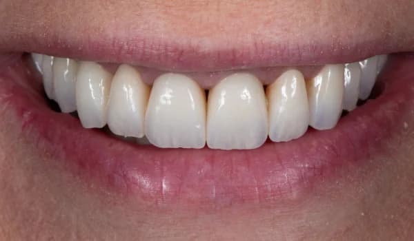 Estetické premeny - prípad 9 – po ošetrení v Planeta Dental Clinic v Žiline