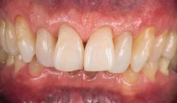 Bielenie zubov - prípad 1 – po ošetrení v Planeta Dental Clinic v Žiline