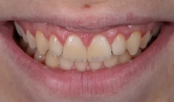 Úrazy - prípad 2 – po ošetrení v Planeta Dental Clinic v Žiline