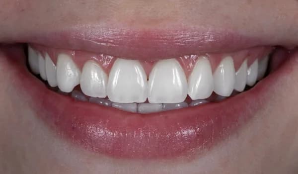 Bielenie zubov - prípad 2 – po ošetrení v Planeta Dental Clinic v Žiline