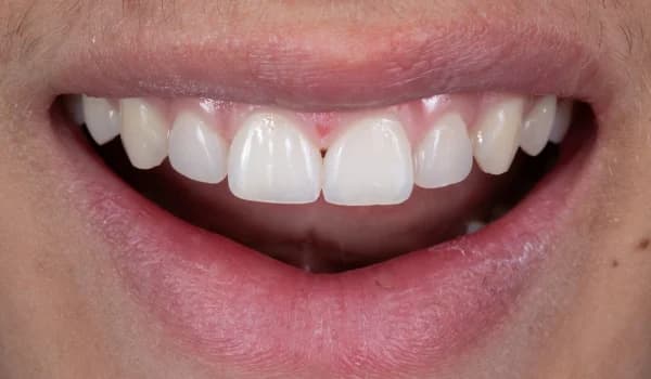Estetické premeny - prípad 12 – po ošetrení v Planeta Dental Clinic v Žiline
