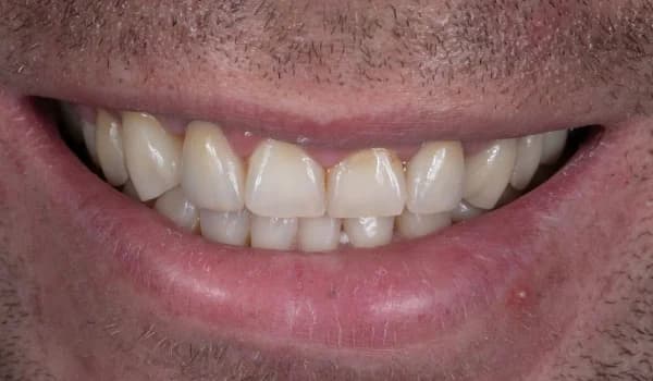 Estetické premeny - prípad 8 – po ošetrení v Planeta Dental Clinic v Žiline
