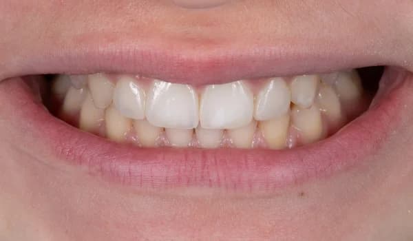 Estetické premeny - prípad 11 – po ošetrení v Planeta Dental Clinic v Žiline